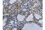 The image on the left is immunohistochemistry of paraffin-embedded Human thyroid cancer tissue using CSB-PA259179(BCOR Antibody) at dilution 1/15, on the right is treated with fusion protein. (Original magnification: 