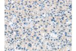 The image on the left is immunohistochemistry of paraffin-embedded Human liver cancer tissue using CSB-PA259468(CD63 Antibody) at dilution 1/25, on the right is treated with synthetic peptide. (Original magnification: 