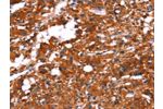 The image on the left is immunohistochemistry of paraffin-embedded Human thyroid cancer tissue using CSB-PA259482(FEM1A Antibody) at dilution 1/20, on the right is treated with synthetic peptide. (Original magnification: 