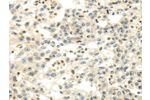 The image on the left is immunohistochemistry of paraffin-embedded Human breast cancer tissue using CSB-PA259822(CDKN1A Antibody) at dilution 1/30, on the right is treated with fusion protein. (Original magnification: 