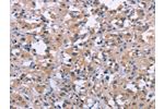 The image on the left is immunohistochemistry of paraffin-embedded Human thyroid cancer tissue using CSB-PA259888(DUSP1 Antibody) at dilution 1/30, on the right is treated with synthetic peptide. (Original magnification: 