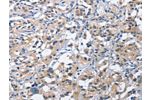 The image on the left is immunohistochemistry of paraffin-embedded Human thyroid cancer tissue using CSB-PA260295(CEACAM3 Antibody) at dilution 1/60, on the right is treated with fusion protein. (Original magnification: 