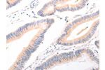 The image on the left is immunohistochemistry of paraffin-embedded Human colon cancer tissue using CSB-PA260955(ACR Antibody) at dilution 1/20, on the right is treated with synthetic peptide. (Original magnification: 