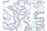The image on the left is immunohistochemistry of paraffin-embedded Human thyroid cancer tissue using CSB-PA261035(ADAM17 Antibody) at dilution 1/15, on the right is treated with fusion protein. (Original magnification: 