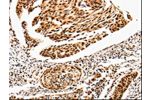 The image is immunohistochemistry of paraffin-embedded Human cervical cancer tissue using CSB-PA261295(ANGPTL4 Antibody) at dilution 1/25. (Original magnification: 