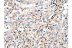 The image on the left is immunohistochemistry of paraffin-embedded Human esophagus cancer tissue using CSB-PA261651(DUSP14 Antibody) at dilution 1/20, on the right is treated with fusion protein. (Original magnification: 