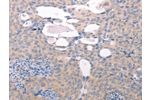 The image on the left is immunohistochemistry of paraffin-embedded Human cervical cancer tissue using CSB-PA261772(ABCF1 Antibody) at dilution 1/40, on the right is treated with fusion protein. (Original magnification: 