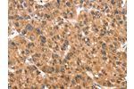 The image on the left is immunohistochemistry of paraffin-embedded Human liver cancer tissue using CSB-PA262326(DAP Antibody) at dilution 1/40, on the right is treated with synthetic peptide. (Original magnification: 
