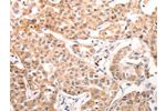 The image on the left is immunohistochemistry of paraffin-embedded Human lung cancer tissue using CSB-PA262645(CCR3 Antibody) at dilution 1/40, on the right is treated with synthetic peptide. (Original magnification: 