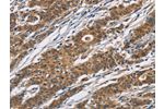 The image on the left is immunohistochemistry of paraffin-embedded Human gastic cancer tissue using CSB-PA263571(CYP21A2 Antibody) at dilution 1/60, on the right is treated with fusion protein. (Original magnification: 