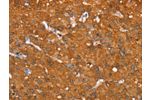 The image on the left is immunohistochemistry of paraffin-embedded Human liver cancer tissue using CSB-PA263631(AKR1C4 Antibody) at dilution 1/25, on the right is treated with fusion protein. (Original magnification: 
