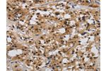 The image on the left is immunohistochemistry of paraffin-embedded Human thyroid cancer tissue using CSB-PA263795(E2F4 Antibody) at dilution 1/40, on the right is treated with synthetic peptide. (Original magnification: 