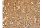 The image on the left is immunohistochemistry of paraffin-embedded Human liver cancer tissue using CSB-PA263860(CXCR4 Antibody) at dilution 1/50, on the right is treated with fusion protein. (Original magnification: 