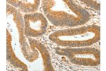 The image on the left is immunohistochemistry of paraffin-embedded Human colon cancer tissue using CSB-PA263919(AKR1B1 Antibody) at dilution 1/30, on the right is treated with synthetic peptide. (Original magnification: 