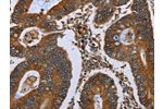 The image on the left is immunohistochemistry of paraffin-embedded Human colon cancer tissue using CSB-PA265803(NUCB2 Antibody) at dilution 1/40, on the right is treated with synthetic peptide. (Original magnification: 