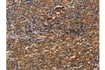 The image on the left is immunohistochemistry of paraffin-embedded Human Lymphoma tissue using CSB-PA265884(CCR5 Antibody) at dilution 1/20, on the right is treated with synthetic peptide. (Original magnification: 