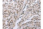 The image on the left is immunohistochemistry of paraffin-embedded Human esophagus cancer tissue using CSB-PA266111(FN1 Antibody) at dilution 1/35, on the right is treated with fusion protein. (Original magnification: 