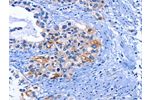The image on the left is immunohistochemistry of paraffin-embedded Human cervical cancer tissue using CSB-PA267352(CDK2 Antibody) at dilution 1/25, on the right is treated with fusion protein. (Original magnification: 