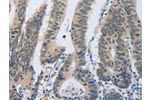 The image on the left is immunohistochemistry of paraffin-embedded Human colon cancer tissue using CSB-PA267410(F2R Antibody) at dilution 1/40, on the right is treated with synthetic peptide. (Original magnification: 