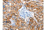 The image on the left is immunohistochemistry of paraffin-embedded Human esophagus cancer tissue using CSB-PA267569(AOX1 Antibody) at dilution 1/65, on the right is treated with fusion protein. (Original magnification: 