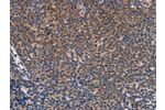 The image on the left is immunohistochemistry of paraffin-embedded Human Lymphoma tissue using CSB-PA267618(CCL23 Antibody) at dilution 1/50, on the right is treated with synthetic peptide. (Original magnification: 