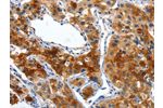The image on the left is immunohistochemistry of paraffin-embedded Human lung cancer tissue using CSB-PA267624(ALPP Antibody) at dilution 1/50, on the right is treated with fusion protein. (Original magnification: 