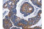 The image on the left is immunohistochemistry of paraffin-embedded Human colon cancer tissue using CSB-PA268035(EEF1G Antibody) at dilution 1/50, on the right is treated with fusion protein. (Original magnification: 
