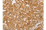 The image on the left is immunohistochemistry of paraffin-embedded Human thyroid cancer tissue using CSB-PA268568(CEBPB Antibody) at dilution 1/60, on the right is treated with synthetic peptide. (Original magnification: 
