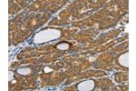 The image on the left is immunohistochemistry of paraffin-embedded Human thyroid cancer tissue using CSB-PA268599(CSF2 Antibody) at dilution 1/30, on the right is treated with fusion protein. (Original magnification: 