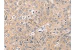 The image on the left is immunohistochemistry of paraffin-embedded Human ovarian cancer tissue using CSB-PA269030(BEST1 Antibody) at dilution 1/20, on the right is treated with synthetic peptide. (Original magnification: 