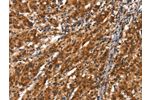 The image on the left is immunohistochemistry of paraffin-embedded Human gastic cancer tissue using CSB-PA269084(CYP2D6 Antibody) at dilution 1/40, on the right is treated with synthetic peptide. (Original magnification: 