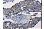 The image on the left is immunohistochemistry of paraffin-embedded Human breast cancer tissue using CSB-PA270018(FGF2 Antibody) at dilution 1/50, on the right is treated with synthetic peptide. (Original magnification: 
