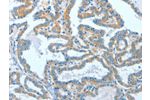 The image on the left is immunohistochemistry of paraffin-embedded Human thyroid cancer tissue using CSB-PA270829(ASCC1 Antibody) at dilution 1/50, on the right is treated with fusion protein. (Original magnification: 