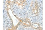 The image on the left is immunohistochemistry of paraffin-embedded Human cervical cancer tissue using CSB-PA271234(ACE Antibody) at dilution 1/80, on the right is treated with synthetic peptide. (Original magnification: 
