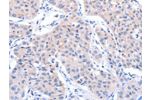 The image on the left is immunohistochemistry of paraffin-embedded Human lung cancer tissue using CSB-PA271275(ACTR3B Antibody) at dilution 1/15, on the right is treated with fusion protein. (Original magnification: 