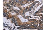 The image on the left is immunohistochemistry of paraffin-embedded Human colon cancer tissue using CSB-PA271638(CLDND1 Antibody) at dilution 1/50, on the right is treated with fusion protein. (Original magnification: 