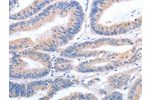 The image on the left is immunohistochemistry of paraffin-embedded Human colon cancer tissue using CSB-PA271998(GFRA4 Antibody) at dilution 1/40, on the right is treated with synthetic peptide. (Original magnification: 