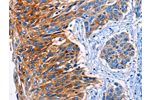 The image on the left is immunohistochemistry of paraffin-embedded Human esophagus cancer tissue using CSB-PA272000(CLEC2B Antibody) at dilution 1/50, on the right is treated with fusion protein. (Original magnification: 