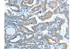 The image on the left is immunohistochemistry of paraffin-embedded Human thyroid cancer tissue using CSB-PA272345(ALDH3B1 Antibody) at dilution 1/20, on the right is treated with fusion protein. (Original magnification: 