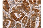 The image on the left is immunohistochemistry of paraffin-embedded Human gastic cancer tissue using CSB-PA272721(ALDH3A1 Antibody) at dilution 1/55, on the right is treated with fusion protein. (Original magnification: 