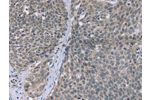 The image on the left is immunohistochemistry of paraffin-embedded Human cervical cancer tissue using CSB-PA272939(FANCG Antibody) at dilution 1/30, on the right is treated with fusion protein. (Original magnification: 
