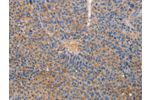 The image on the left is immunohistochemistry of paraffin-embedded Human liver cancer tissue using CSB-PA273344(CXCL3 Antibody) at dilution 1/20, on the right is treated with fusion protein. (Original magnification: 