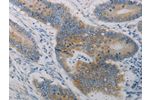 The image on the left is immunohistochemistry of paraffin-embedded Human colon cancer tissue using CSB-PA273524(CLEC4C Antibody) at dilution 1/50, on the right is treated with synthetic peptide. (Original magnification: 