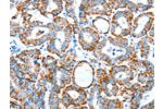 The image on the left is immunohistochemistry of paraffin-embedded Human thyroid cancer tissue using CSB-PA273719(ALDH5A1 Antibody) at dilution 1/60, on the right is treated with synthetic peptide. (Original magnification: 