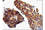 The image on the left is immunohistochemistry of paraffin-embedded Human lung cancer tissue using CSB-PA274173(ADD1 Antibody) at dilution 1/50, on the right is treated with fusion protein. (Original magnification: 