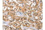 The image on the left is immunohistochemistry of paraffin-embedded Human thyroid cancer tissue using CSB-PA274333(DKK3 Antibody) at dilution 1/30, on the right is treated with fusion protein. (Original magnification: 