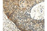 The image on the left is immunohistochemistry of paraffin-embedded Human esophagus cancer tissue using CSB-PA274413(ABCB7 Antibody) at dilution 1/20, on the right is treated with fusion protein. (Original magnification: 
