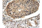 The image on the left is immunohistochemistry of paraffin-embedded Human esophagus cancer tissue using CSB-PA275426(FOXK1  Antibody) at dilution 1/20, on the right is treated with synthetic peptide. (Original magnification: 