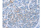 The image on the left is immunohistochemistry of paraffin-embedded Human breast cancer tissue using CSB-PA275606(CLDN4 Antibody) at dilution 1/50, on the right is treated with synthetic peptide. (Original magnification: 