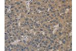 The image on the left is immunohistochemistry of paraffin-embedded Human liver cancer tissue using CSB-PA276232(EMC8 Antibody) at dilution 1/30, on the right is treated with fusion protein. (Original magnification: 